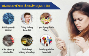 Nguyên nhân gây rụng tóc của chị em 