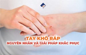 Tay khô ráp: Nguyên nhân và giải pháp khắc phục