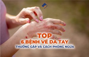 Top 6 bệnh về da tay thường gặp và cách phòng ngừa