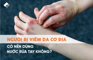 Người bị viêm da cơ địa có nên dùng nước rửa tay không?