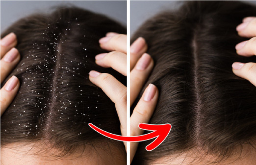 Hướng dẫn gội đầu trị gàu đúng cách tại nhà