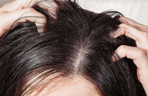 Gàu là gì và vì sao bạn lại bị gàu