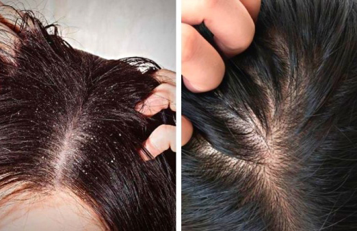 2. Trải nghiệm 1: Dầu gội thiên nhiên giảm gàu từ từ nhưng ổn định